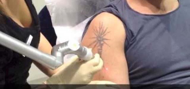 Removing Tattoos With Lasers