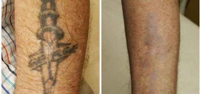 Tattoo Removal – Sources Of Your Unwanted Tattoo