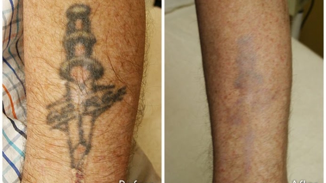 Tattoo Removal – Sources Of Your Unwanted Tattoo