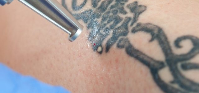 Tattoo Removal Cream – Which Is The Perfect?