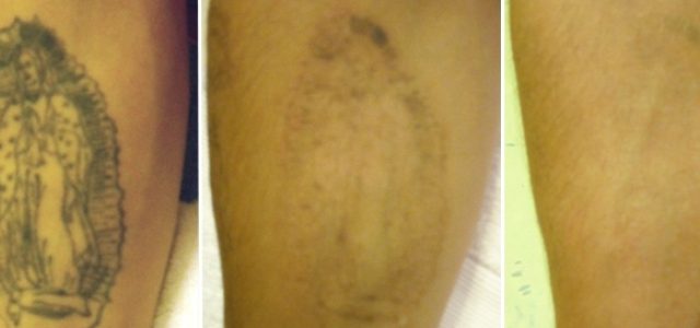 The Price Tattoo Removal: Read This And Complications Money