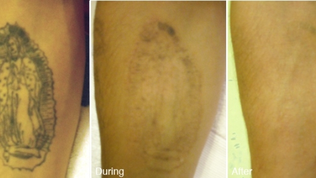 The Price Tattoo Removal: Read This And Complications Money