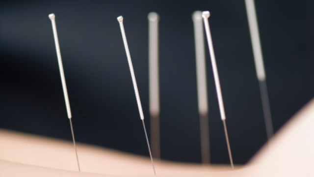 The Art of Acupuncture: Unleashing the Body’s Healing Powers