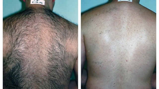 Say Goodbye to Unwanted Hair: Unlocking the Power of Laser Hair Removal